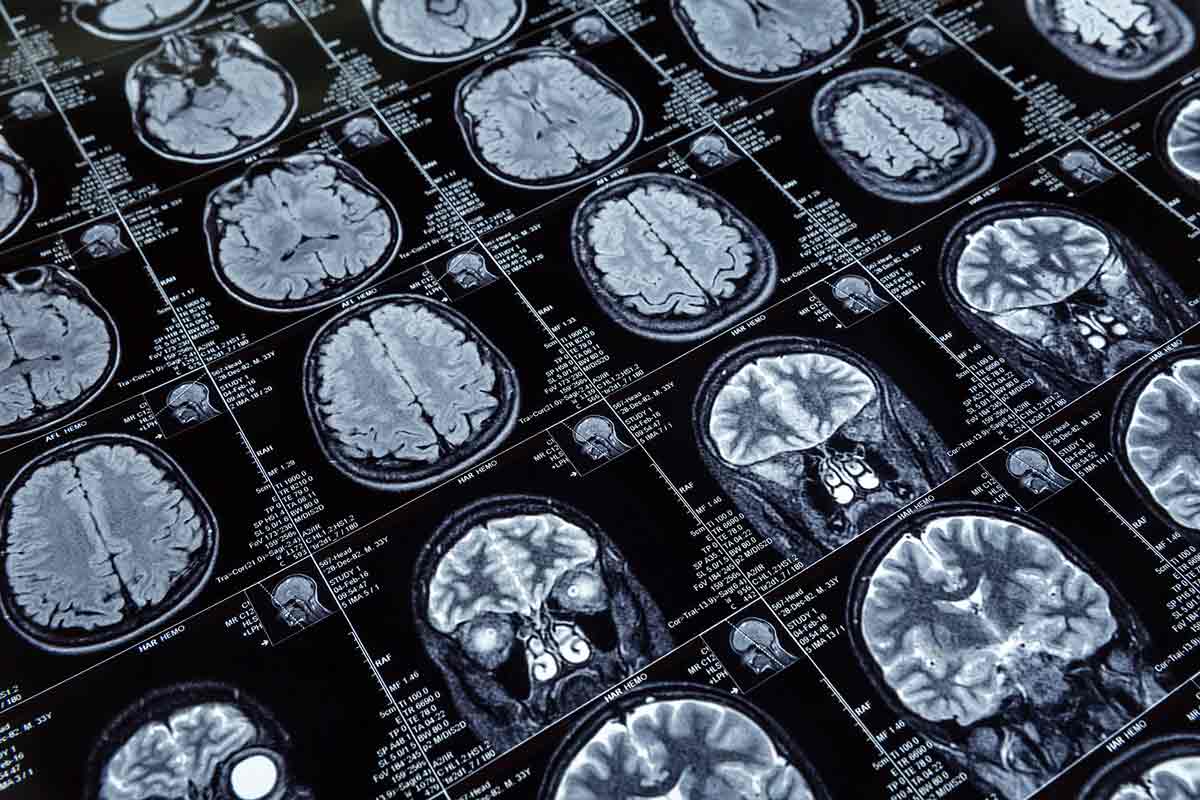 Alzheimer’s disease brain topography